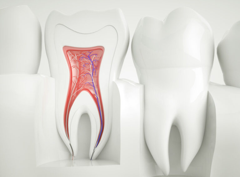 Dente mancante: cosa succede se non lo sostituisci illustrazione di un dente da devitalizzare con polpa dentale e canali radicolari evidenziati