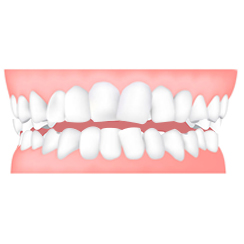 Ortodonzia per Adulti invisalign