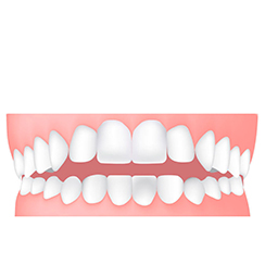 Ortodonzia per Adulti invisalign