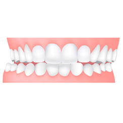 Ortodonzia per Adulti invisalign