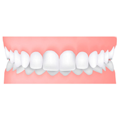 Ortodonzia per Adulti invisalign
