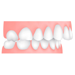 Ortodonzia per Adulti invisalign