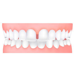 Ortodonzia per Adulti invisalign